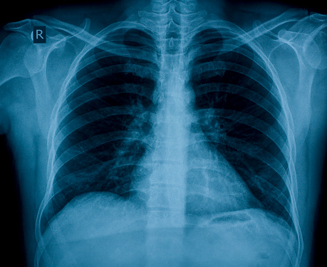 Chest X-ray image for physician's examination