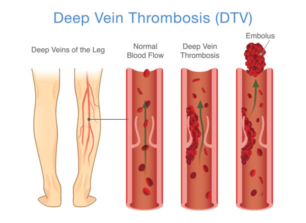 ilustrações de stock, clip art, desenhos animados e ícones de medical diagram of deep vein thrombosis at leg area. - coágulo