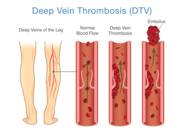 медицинская диаграмма тромбоза глубоких вен в области ног. - thrombus stock illustrations