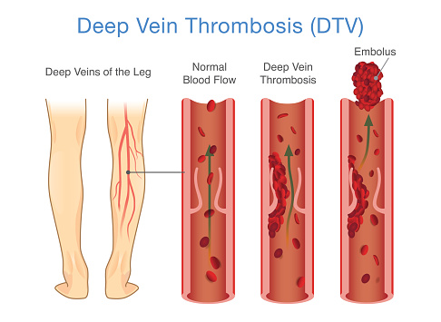 Medical Diagram of Deep Vein Thrombosis at leg area. Illustration about abnormally of blood floow.