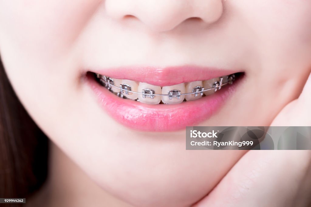 close up woman wear brace close up of woman wear brace and touch her face for your health concept Dental Braces Stock Photo