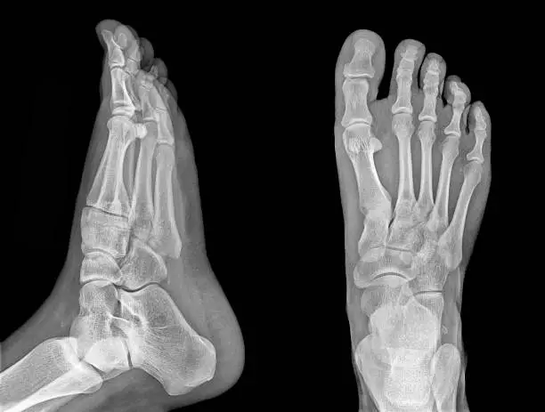 Detail of an x-ray of a foot