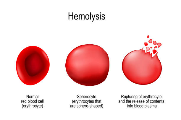 용 혈입니다. 정상적인 적혈구, spherocyte, 및 e의 파열 - blood cell anemia cell structure red blood cell stock illustrations