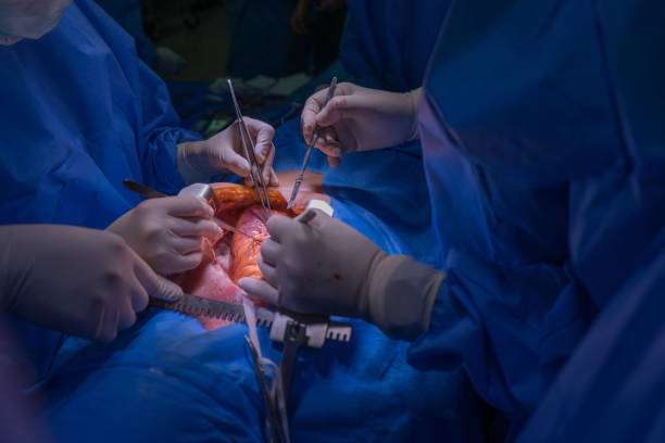manteau de médecins équipe usure bleu effectuer une chirurgie cardiaque à la salle d’opération à l’hôpital. - transplantation cardiaque photos et images de collection