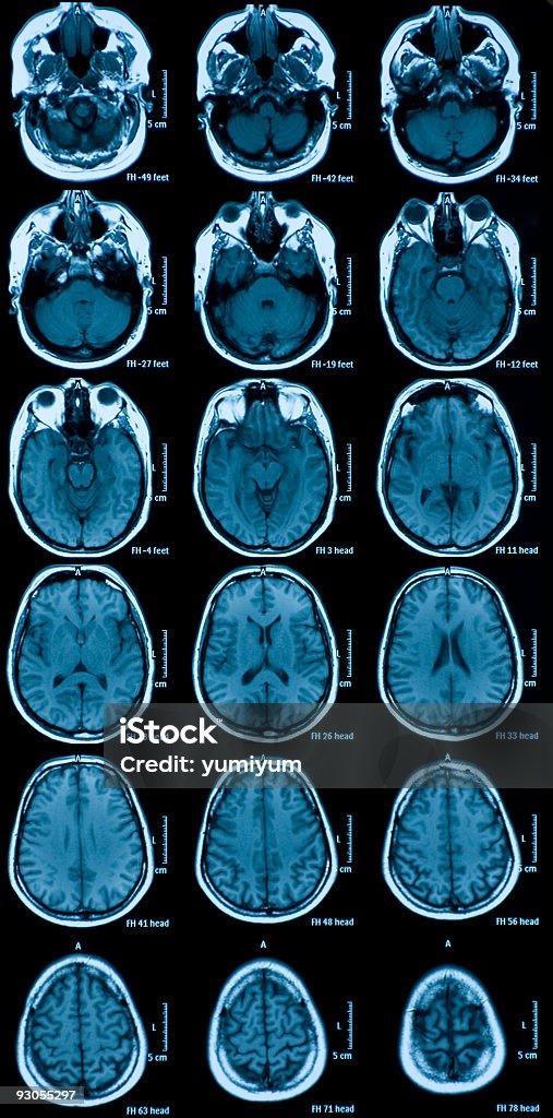 MRI スキャンの脳 - X線撮影のロイヤリティフリーストックフォト