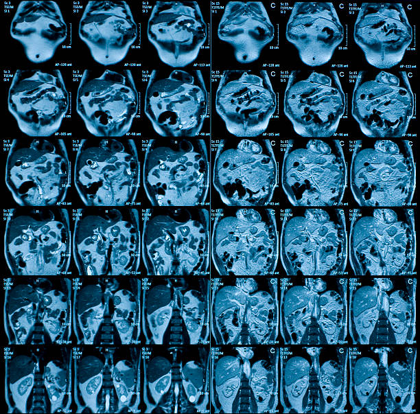 istock MRI scan of abdomen 93055929