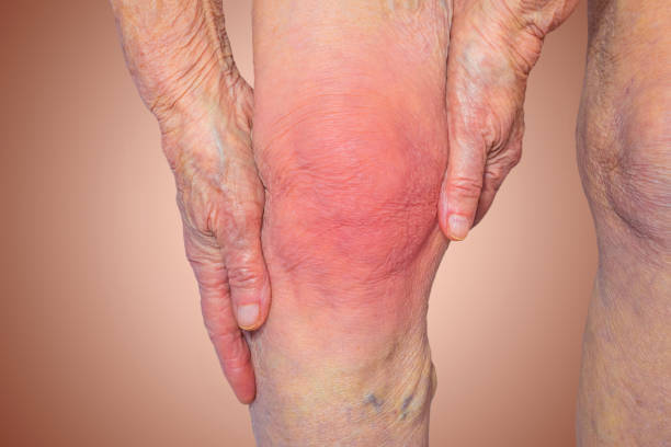 痛みで膝を保持している年配の女性 - arthritis senior adult rheumatoid arthritis sadness ストックフォトと画像