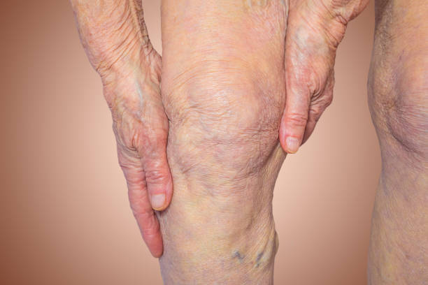 痛みで膝を保持している年配の女性 - arthritis senior adult rheumatoid arthritis sadness ストックフォトと画像