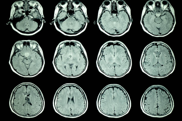 istock MRI scan of patient brain 930712288