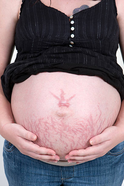 A pregnant woman holding her stomach and stretch marks stock photo