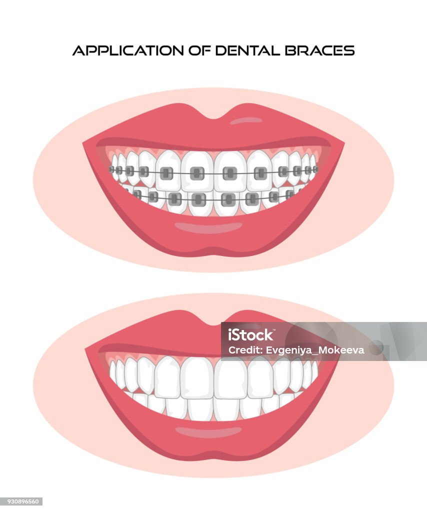 Ilustración de Dientes Con Brackets Sobre Fondo Blanco y más Vectores  Libres de Derechos de Instrumento de dentista - Instrumento de dentista,  Salud dental, Ajustar - iStock