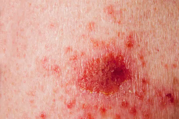 Photo of Basal Cell Carcinoma Cancer Treatment with Topical Medicine