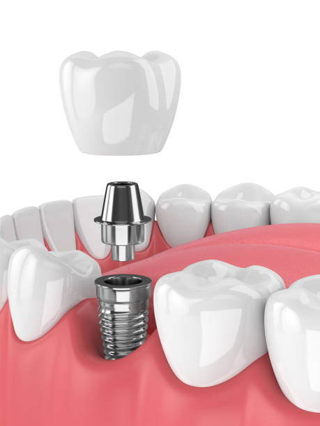 istock 3d render of jaw with teeth and dental molar implant 931117596