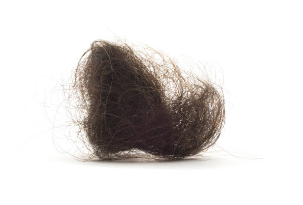 File:Trichotillomania 2.jpg - Wikipedia