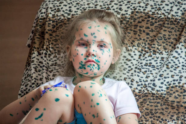 かわいい女の子 3-4-5 の肖像歳の悲しい目、水痘、体に斑点の色、緑の薬を塗りたくりのにきび。 - chicken tender ストックフォトと画像