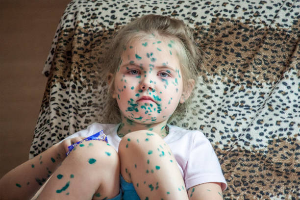 portrait of cute little girl 3-4-5 years old with sad eyes, with  chickenpox, pimples anointed with green medicinal preparations, colored spots on the body. - child caucasian little girls 3 4 years imagens e fotografias de stock