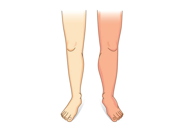 Human Leg swelling in front view. Human Leg swelling in front view. Illustration about the diseases and conditions of fluid gathers in foot and leg. big feet cartoon stock illustrations