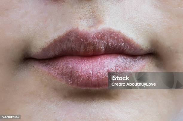 Hipersensibles A Secar Los Labios Labios Alérgico A Productos Químicos Negro Labios Labios Foto de stock y más banco de imágenes de Seco