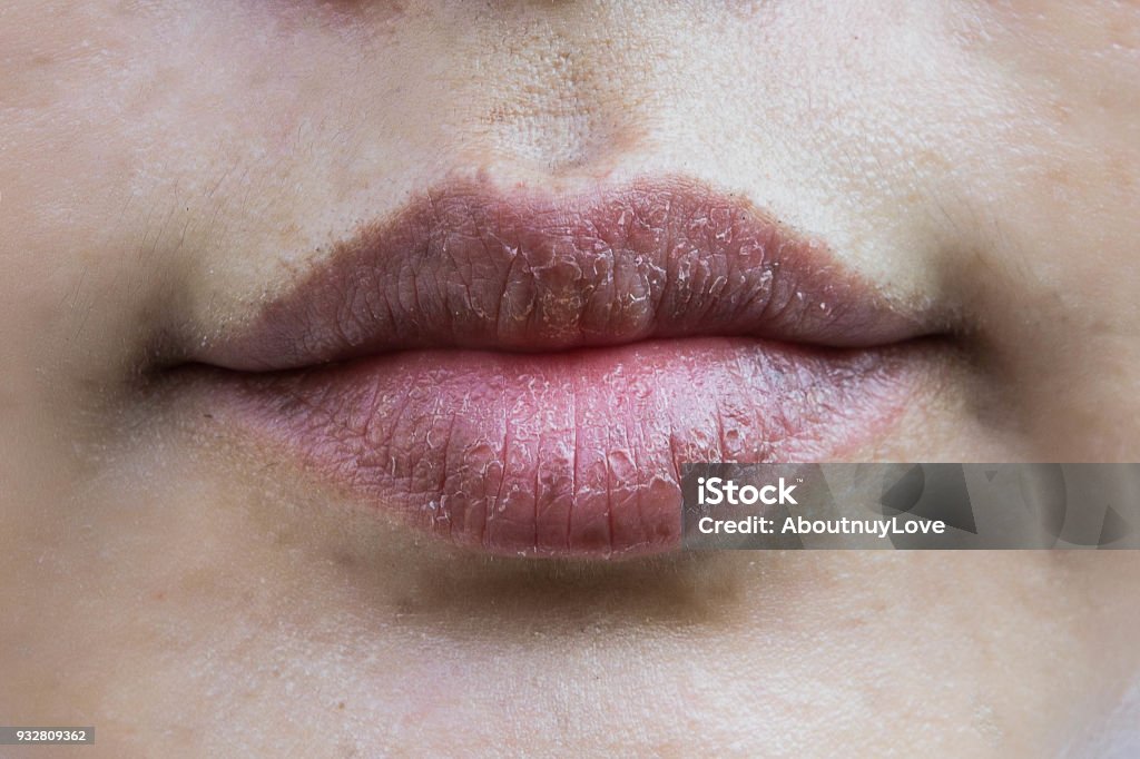 Lips hypersensitive to dry lips, Lips allergic to chemicals , Black lips Dry Stock Photo