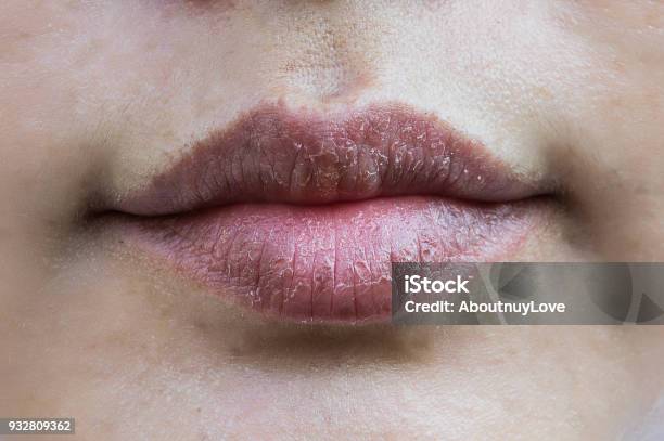 Lips Hypersensitive To Dry Lips Lips Allergic To Chemicals Black Lips Stock Photo - Download Image Now