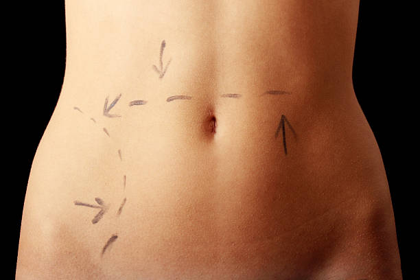 Quais os riscos de uma cirurgia de otoplastia?