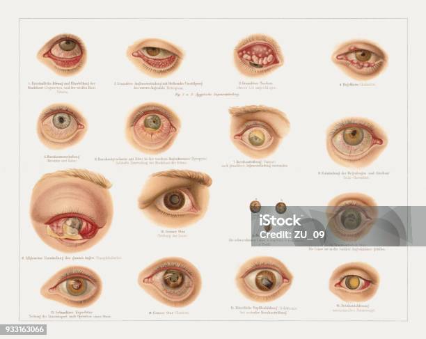 Eye Diseases Lithograph Published In 1897 Stock Illustration - Download Image Now - Eye, Illness, Anatomy