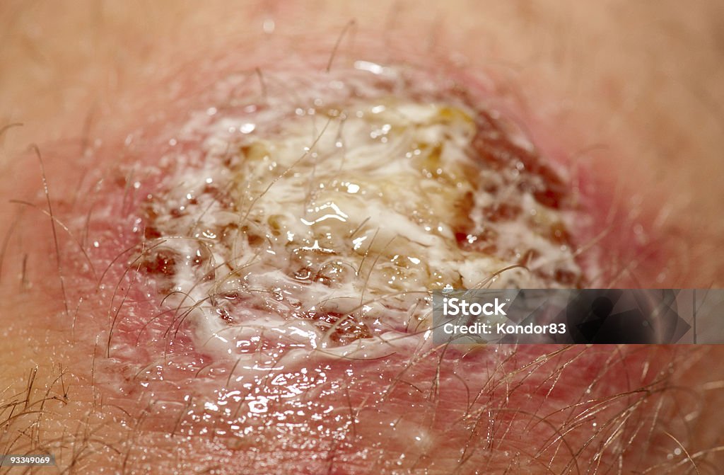 Wound covered with antibacterial gel Wound covered with antibacterial gel. It's not a makeup Infectious Disease Stock Photo