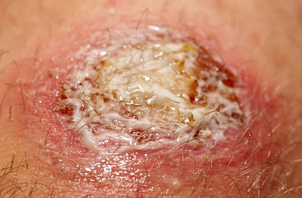 Wound covered with antibacterial gel Wound covered with antibacterial gel. It's not a makeup infected wound stock pictures, royalty-free photos & images