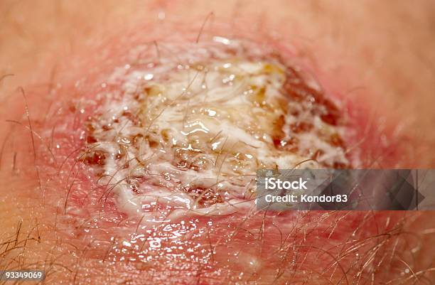 Wound Covered With Antibacterial Gel Stock Photo - Download Image Now - Infectious Disease, Wound, Disinfection