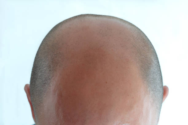 istock View of bald man's head 933790070