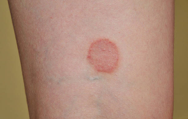 lichen ruber planus  ringworm photos stock pictures, royalty-free photos & images