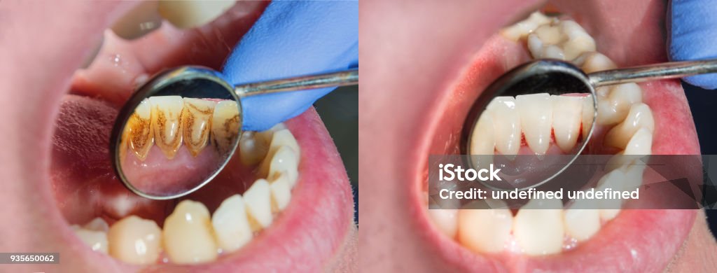 Plaque of the patient, stone. Dentistry treatment of dental plaque, professional oral hygiene. The concept of harm to smoking and cleaning teeth Teeth Stock Photo