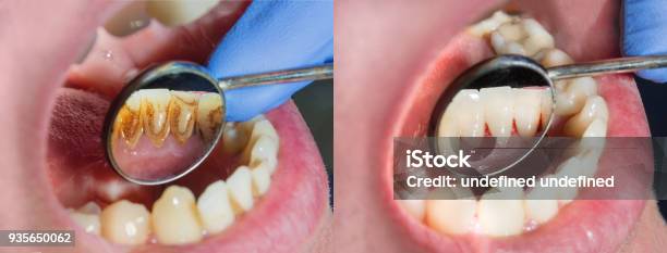 Plaque Of The Patient Stone Dentistry Treatment Of Dental Plaque Professional Oral Hygiene The Concept Of Harm To Smoking And Cleaning Teeth Stock Photo - Download Image Now