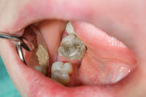 close-up of a human rotten carious tooth at the treatment stage in a dental clinic. The use of rubber dam system with latex scarves and metal clips, production of photo polymeric composite fillings