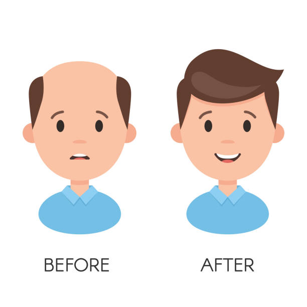 Male Hair Loss Stock Illustration - Download Image Now - Hair Loss, Men,  Completely Bald - iStock