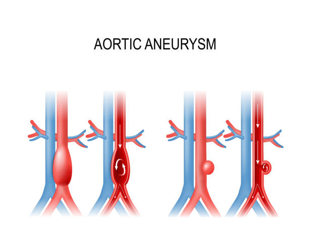 aortenaneurysma - endhirn stock-grafiken, -clipart, -cartoons und -symbole