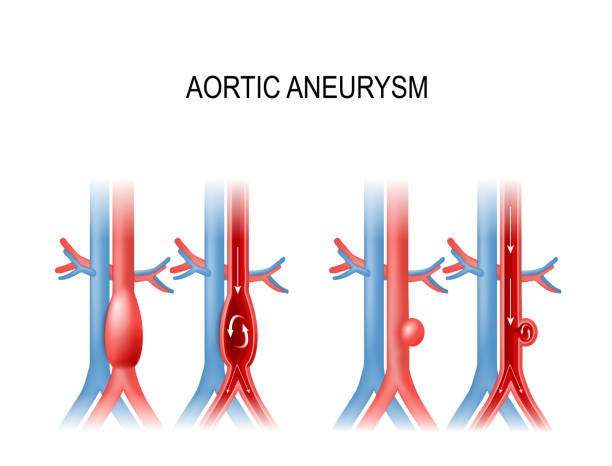 aortic aneurysm vector art illustration