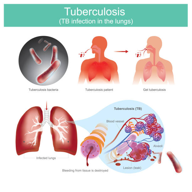 ilustrações, clipart, desenhos animados e ícones de tb tuberculose nos pulmões. - human lung tuberculosis bacterium emphysema human trachea