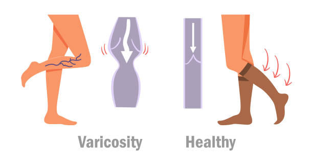 stockillustraties, clipart, cartoons en iconen met varicosity. benen. vector - woman legs veins