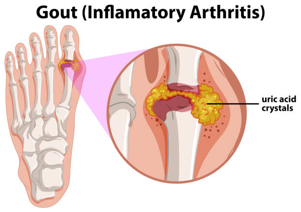 диаграмма, показывающая подагру в человеческой ноге - gout stock illustrations