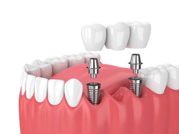 3d render szczęki i implantów z mostkiem dentystycznym - bridge zdjęcia i obrazy z banku zdjęć