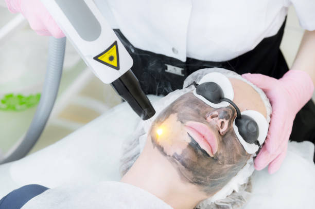 Close-up carbon face peeling procedure. Laser pulses clean skin of the face. Hardware cosmetology treatment. Process of photothermolysis, warming the skin, laser carbon peeling. Facial skin rejuvenation stock photo