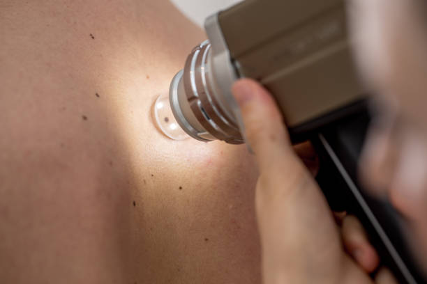 close-up de um mapeamento de toupeira dermatologista nas costas do paciente - cancer de pele - fotografias e filmes do acervo