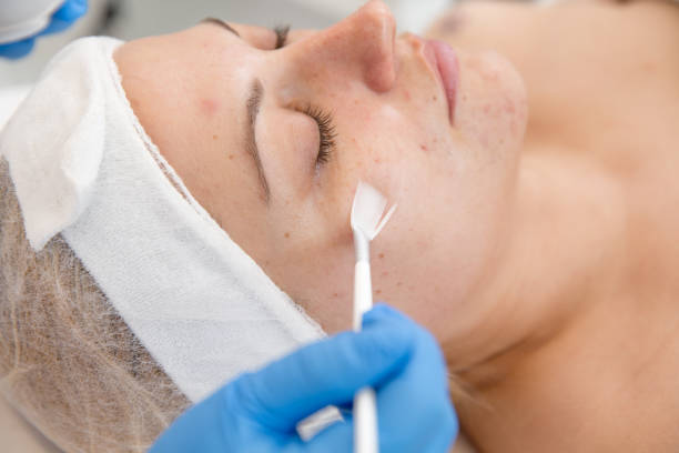 Adult Woman Receiving Skin Chemical Peel Treatment at Dermatologist Adult Woman Receiving Skin Chemical Peel Treatment at Dermatologist. casarsaguru stock pictures, royalty-free photos & images