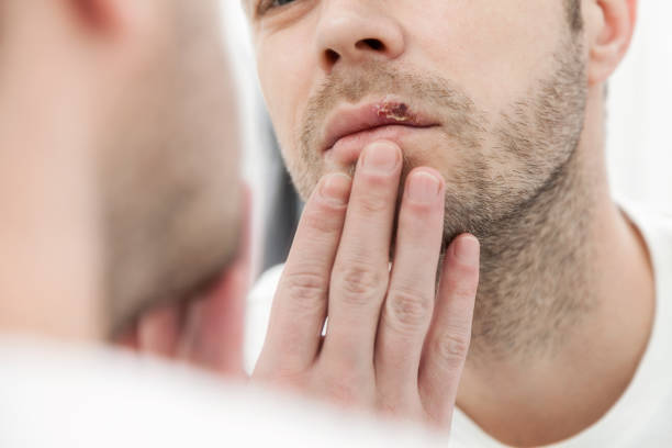 istock Young man suffering from herpes on his mouth 937458558