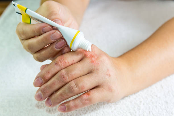 eczéma sur les mains. la femme, appliquer la pommade - eczema photos et images de collection