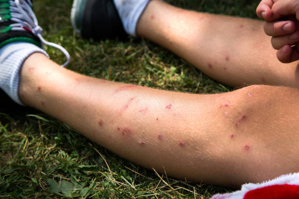 mosquito bites - mosquito child bug bite scratching imagens e fotografias de stock