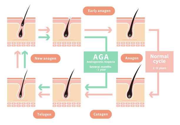 ilustrações, clipart, desenhos animados e ícones de ilustração comparativa do ciclo normal do cabelo e aga (alopecia androgenética) / inglês - alopecia antes depois