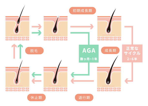 通常の毛周期と aga (男性型脱毛症) の比較図/日本 - 髪型点のイラスト素材／クリップアート素材／マンガ素材／アイコン素材