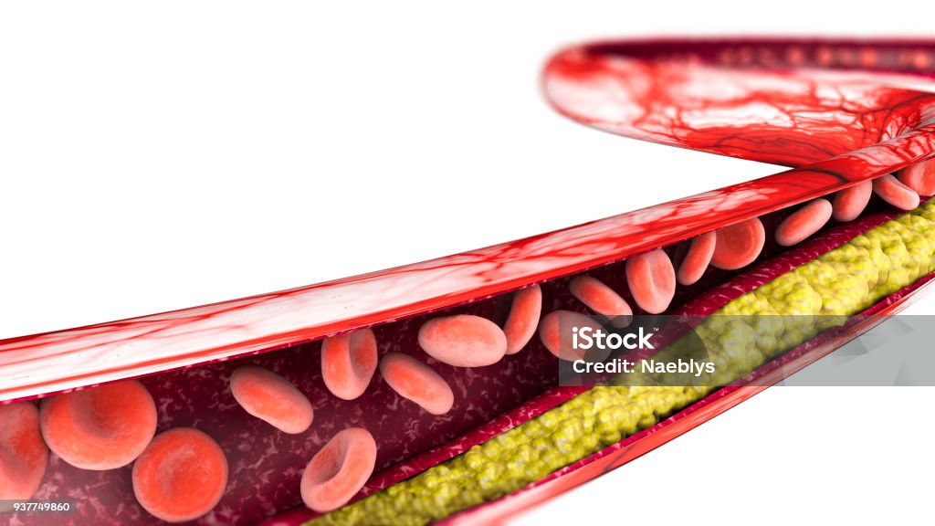Formação de colesterol, gordura, artéria, veia, coração - Foto de stock de Colesterol royalty-free